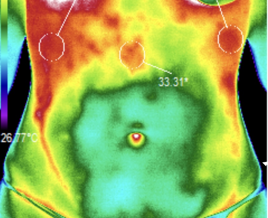 Thermography body scan showing inflammation zones